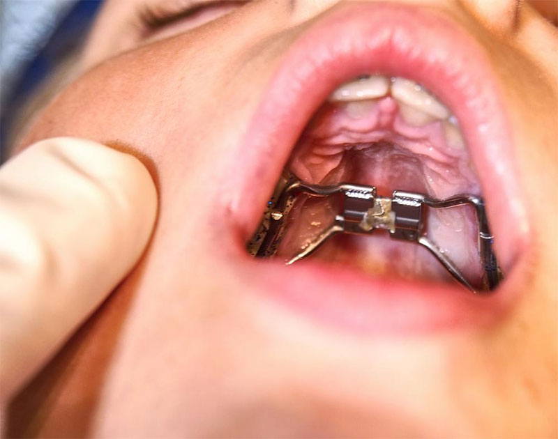 Nong hàm giúp nới rộng hàm răng đối với cung hàm hẹp