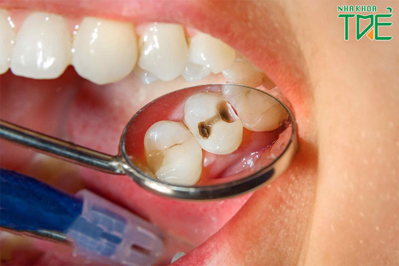 Răng hàm sữa có thay không?
