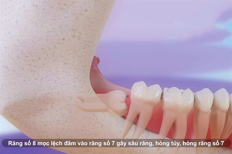 Răng khôn mọc ngầm có nguy hiểm không? có nên nhổ không?