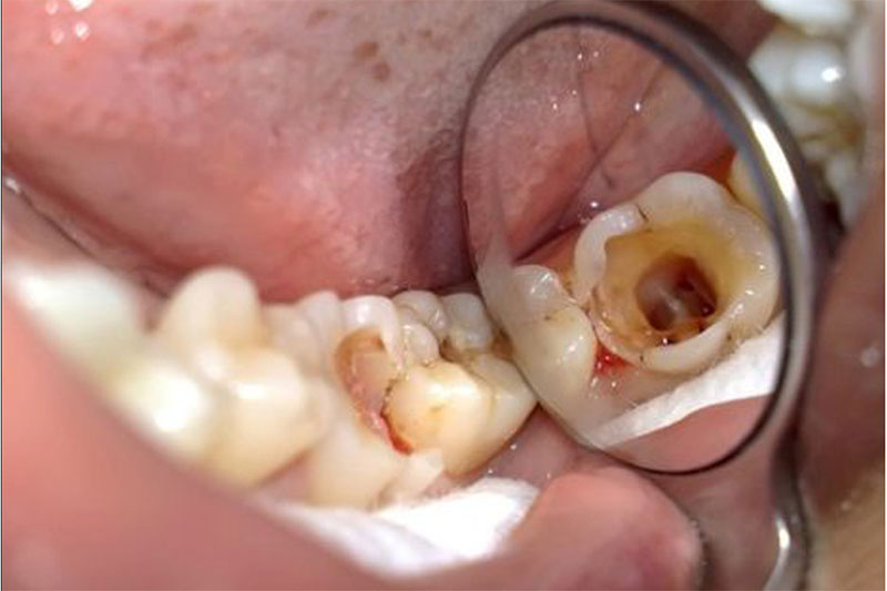 Răng khôn bị sau nên nhổ răng sớm tránh lây lan sang các răng khác