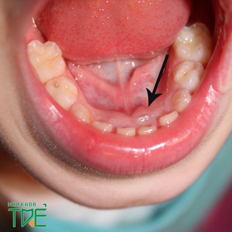 Bệnh lý răng miệng răng sữa chưa rụng đã mọc răng vĩnh viễn có điều trị được không?
