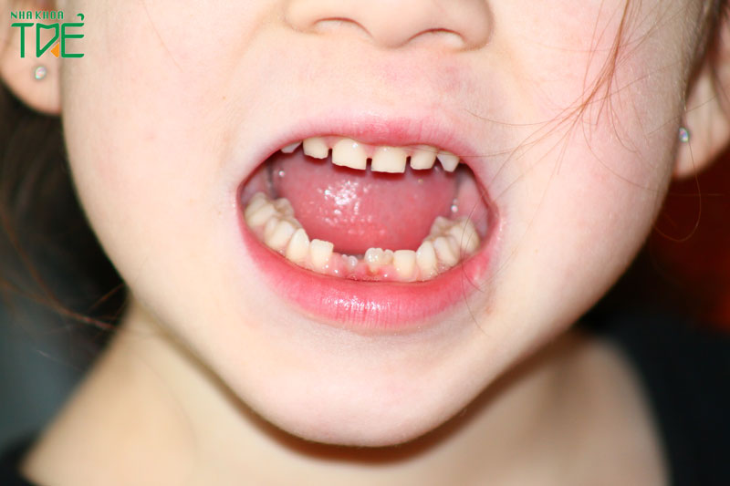 Nhổ răng sữa nhường chỗ cho răng vĩnh viễn mọc thẳng