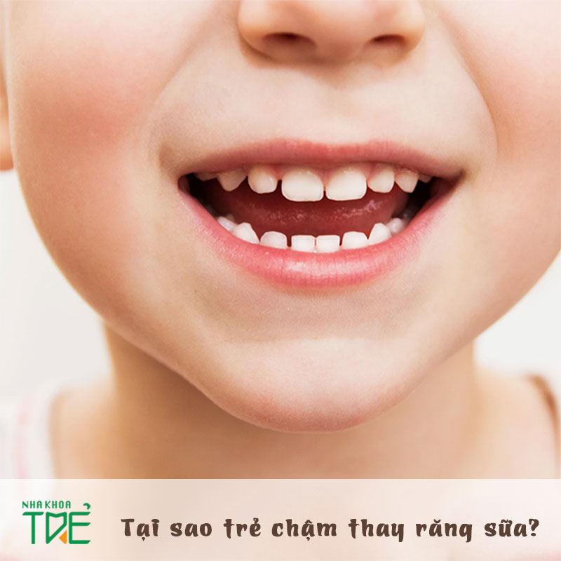 Tại sao trẻ chậm thay răng sữa thành các răng vĩnh viễn?
