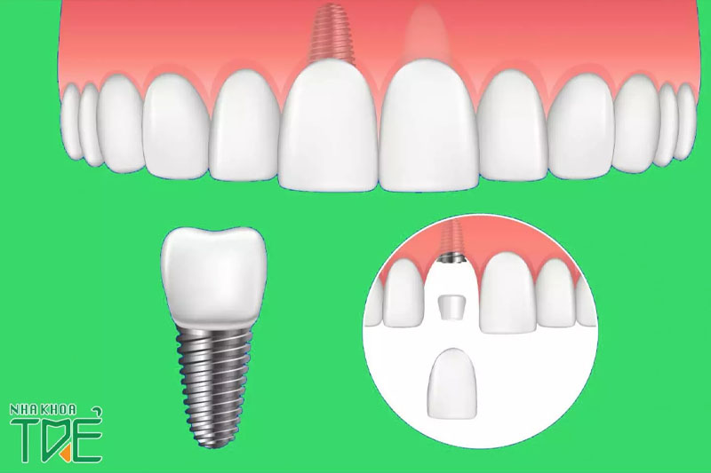 Trồng răng cửa bằng Implant là phương pháp hiệu quả nhất