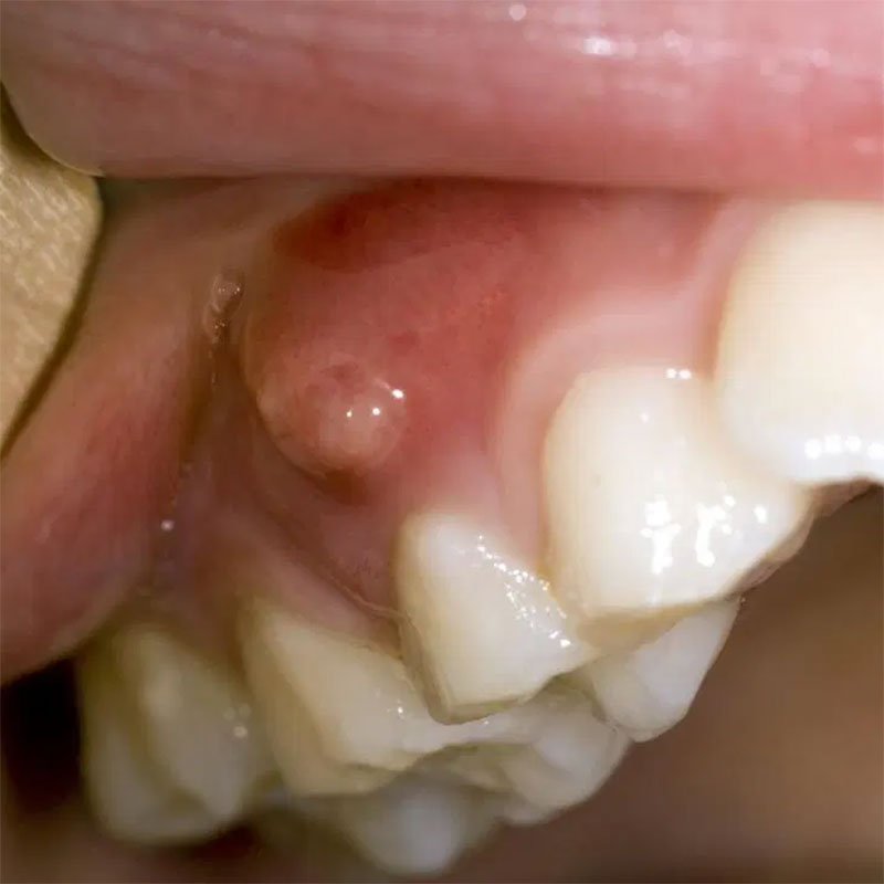 Viêm chân răng ở trẻ em – Nguyên nhân và cách điều trị dứt điểm