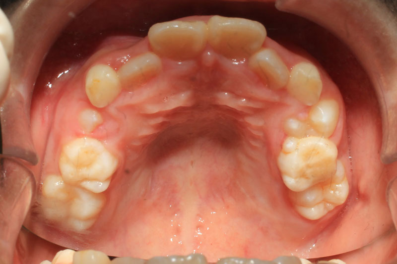 Nhổ răng sữa sớm có thể dẫn đến tình trạng các răng vĩnh viễn mọc lệch lạc