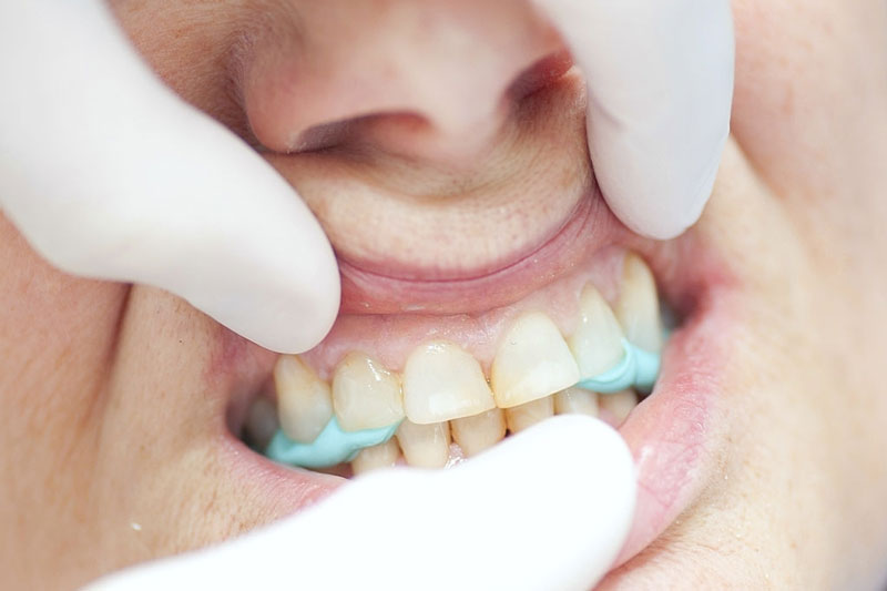 Vệ sinh răng miệng không kỹ lưỡng dễ hình thành mảng bám trên răng