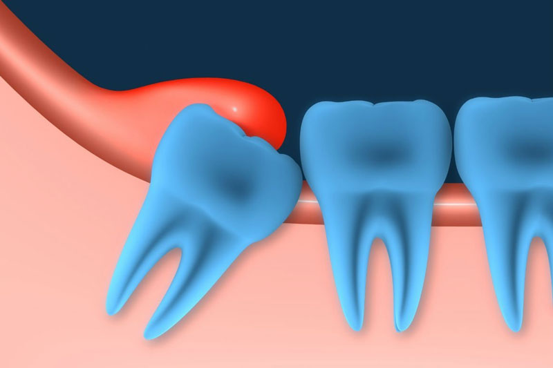 Răng khôn mọc làm sưng nướu, gây đau nhức