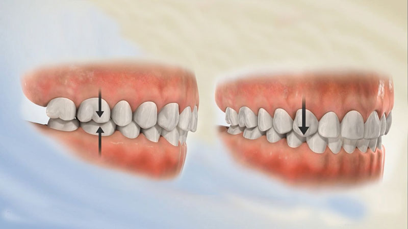 Nhóm răng sau của khớp cắn sâu có tiết diện tiếp xúc ít hơn bình thường