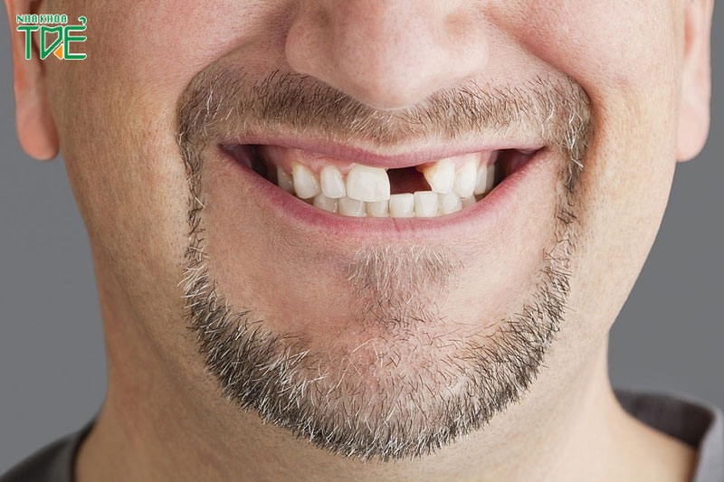 Trường hợp mất 1 răng thì có thể làm cầu răng sứ để phục hình