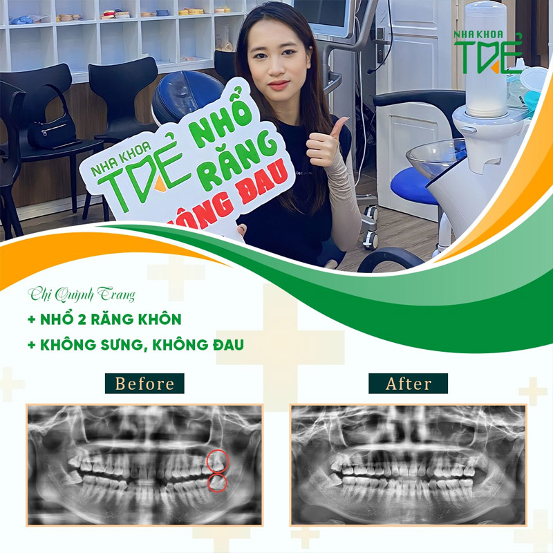 Chị Quỳnh Trang nhổ 2 răng khôn không đau, không sưng tại Nha khoa Trẻ