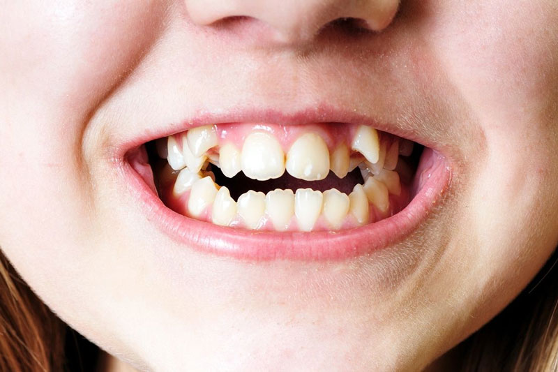 Hai răng khấp khểnh quá mức dẫn đến nhiều nguy cơ cho sức khỏe răng miệng và cơ thể