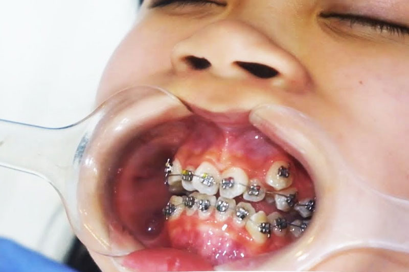 Niềng răng mắc cài kim loại có độ bền chắc cao trong suốt quá trình chỉnh nha