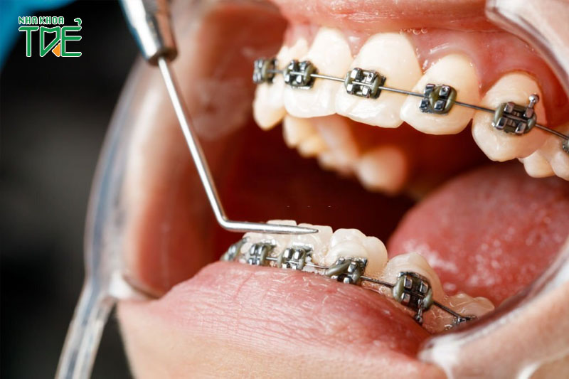 Thời gian niềng răng 3M phụ thuộc vào tình trạng răng
