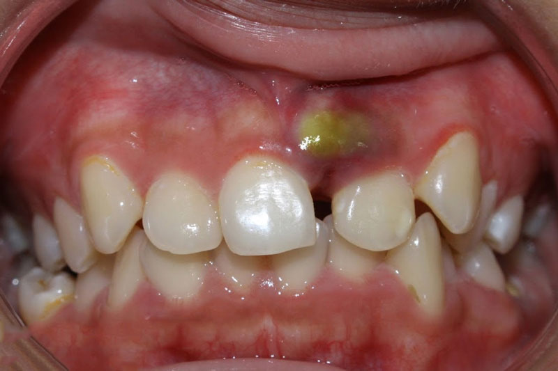 Sử đụng dây thun hoặc thép niềng răng sẽ dẫn đến viêm, nhiễm trùng nướu