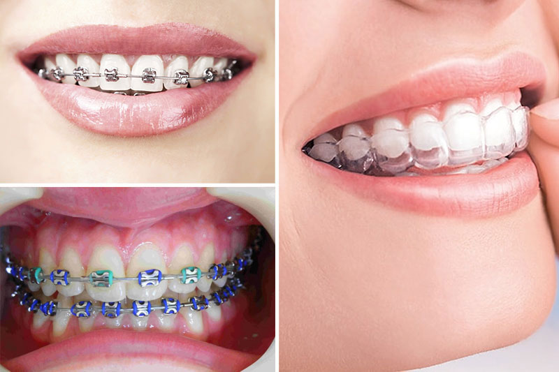 Phương pháp niềng răng tại nha khoa là mắc cài và niềng răng trong suốt