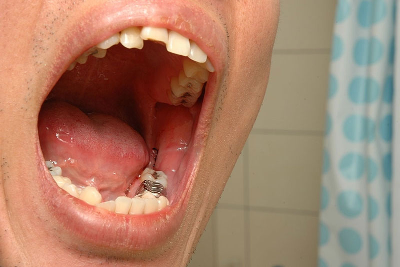 Nhổ răng khôn càng sớm càng tốt tránh biến chứng không mong muốn