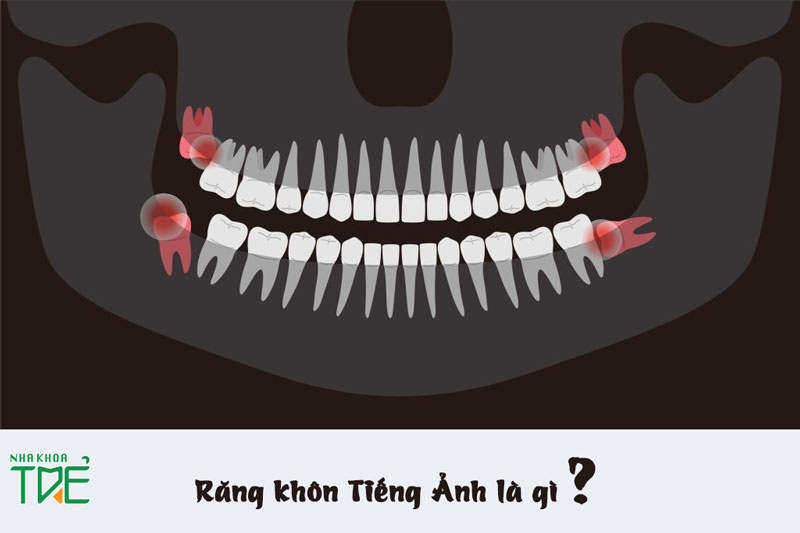 Răng khôn thường mọc lệch mọc ngầm gây ra nhiều biến chứng