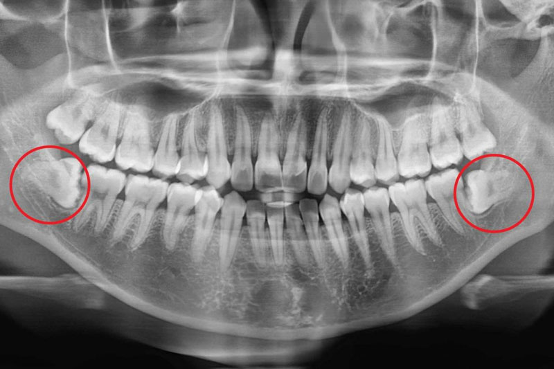 Răng khôn thường mọc lệch mọc ngầm gây ra nhiều biến chứng