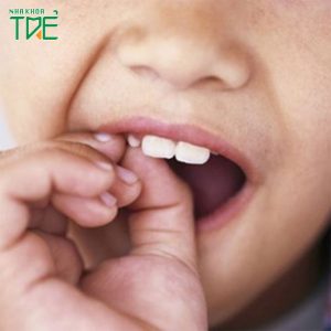 Răng sữa không lung lay có nên nhổ không?