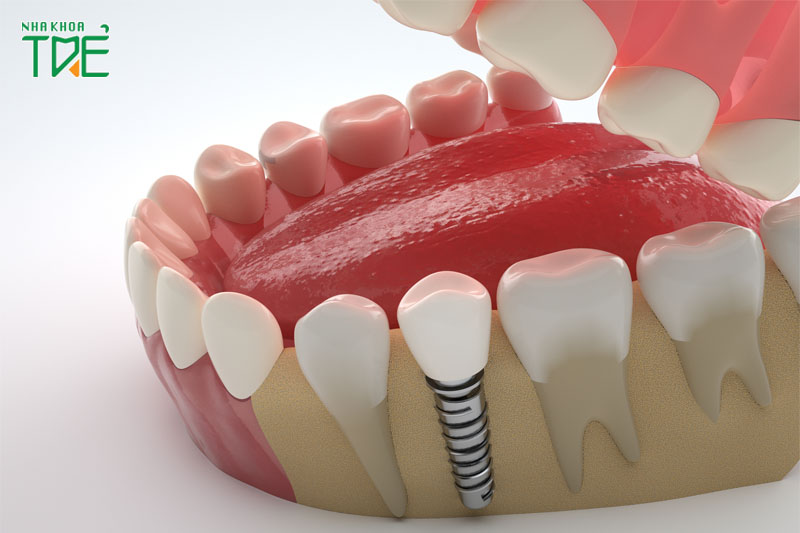 Trồng răng Implant mang lại nhiều lợi ích cho sức khỏe răng miệng