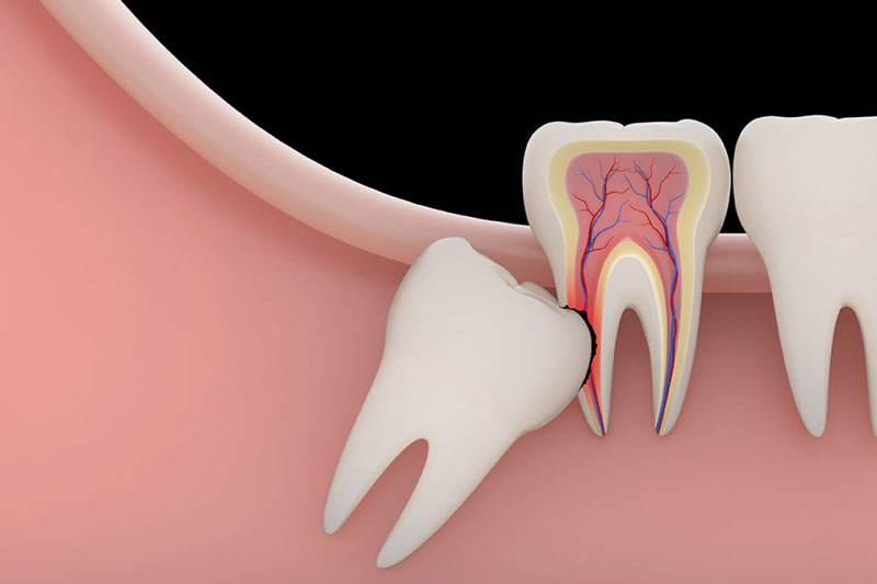 Răng khôn đâm vào răng số 7 thì cần được nhổ bỏ sớm
