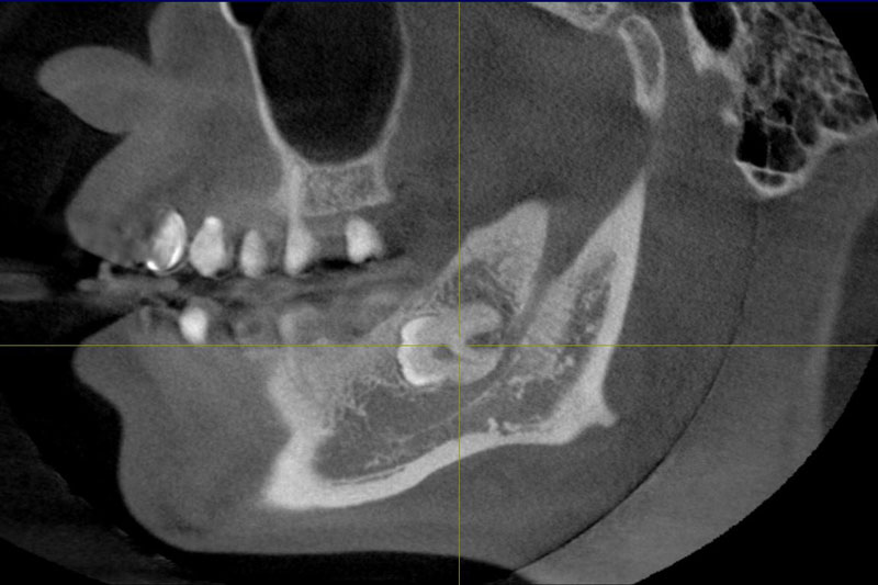 Răng khôn mọc ngầm trong xương, chèn ép dây thần kinh sẽ gây ra biến chứng giao cảm 