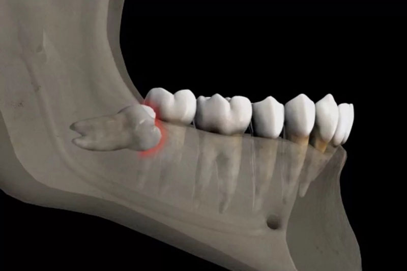 Răng khôn mọc ngầm gây ra nhiều biến chứng nguy hiểm 