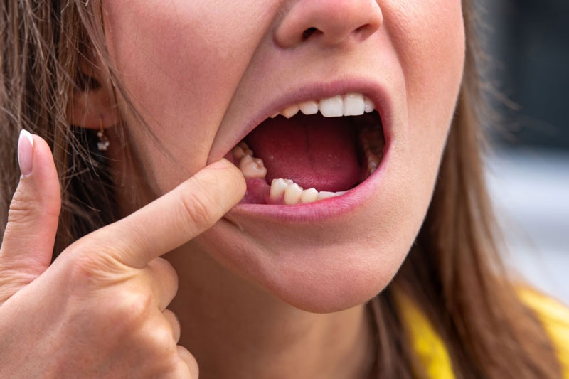 Làm răng sứ trong trường hợp mất một răng hoặc nhiều răng liền kề