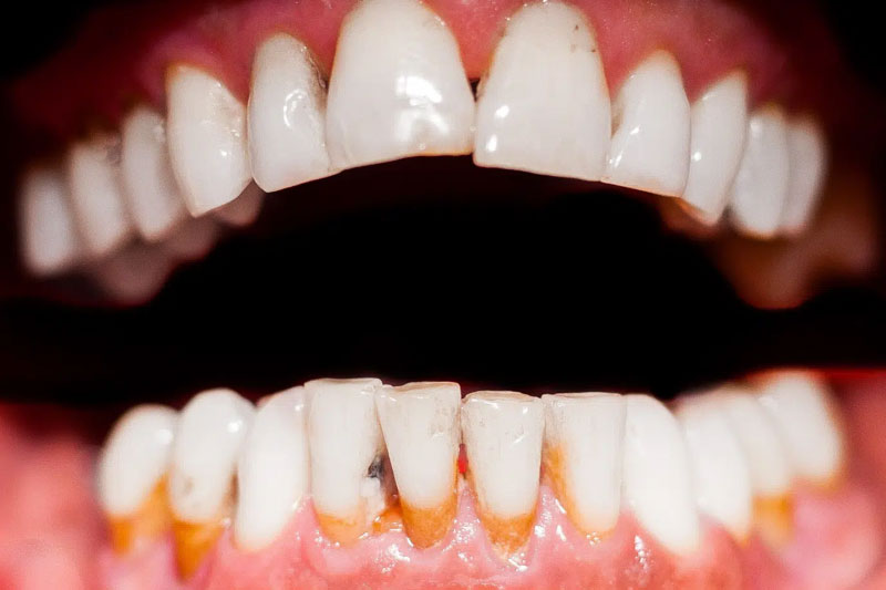 Cần điều trị triệt để bệnh lý răng miệng trước khi tiến hành bọc răng sứ