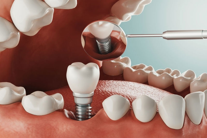 Cấy ghép Implant trực tiếp vào xương hàm của người bệnh để thay thế cho chân răng giả
