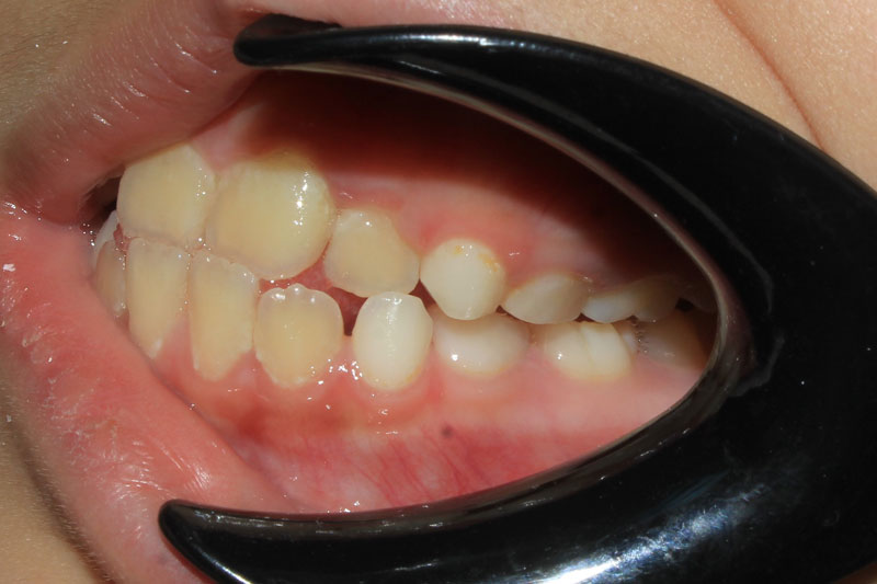 Khớp cắn ngược có biểu hiện răng hàm dưới nằm ngoài răng hàm trên