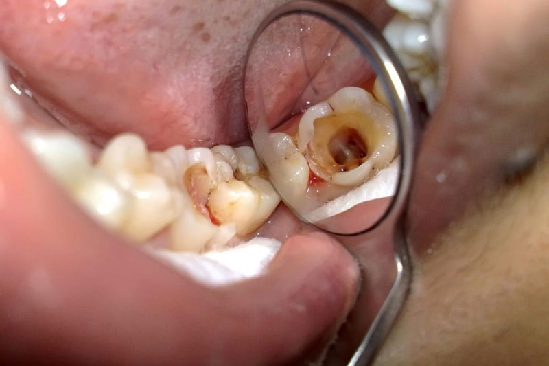 Sâu răng vào đến tủy cần điều trị tủy răng 