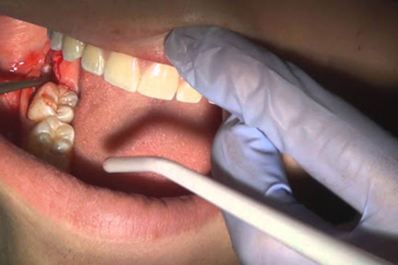 Nhổ răng khôn sai cách có nguy cơ gây ra biến chứng nguy hiểm