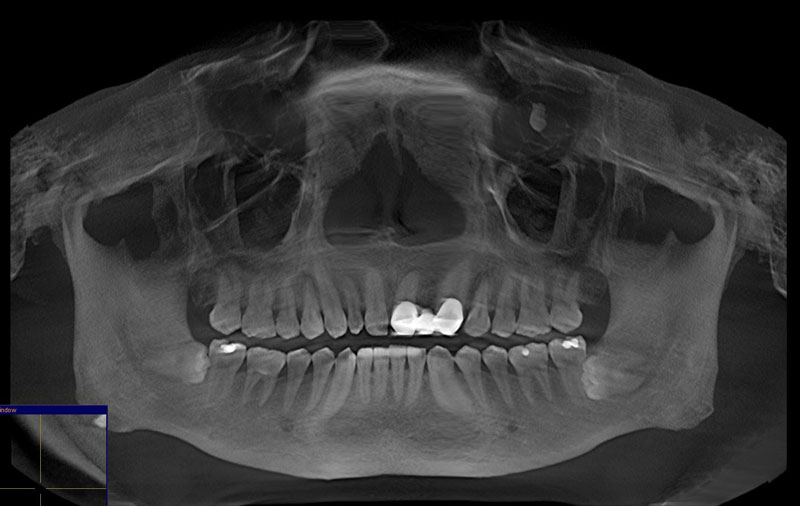 Chụp X-quang răng để xác định chính xác tình trạng răng khôn mọc lệch