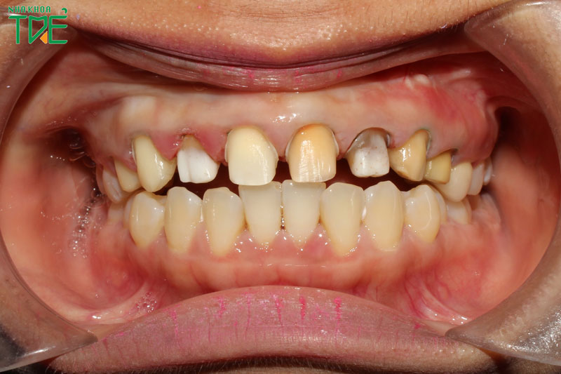 Mài răng bọc răng sứ có gây ảnh hưởng xấu không?