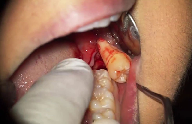 Nhổ răng khôn bị sưng mặt kéo dài có thể là do bác sĩ nhổ răng sai kỹ thuật