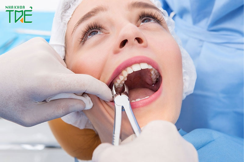 Nhổ răng khôn có ảnh hưởng đến thần kinh không?