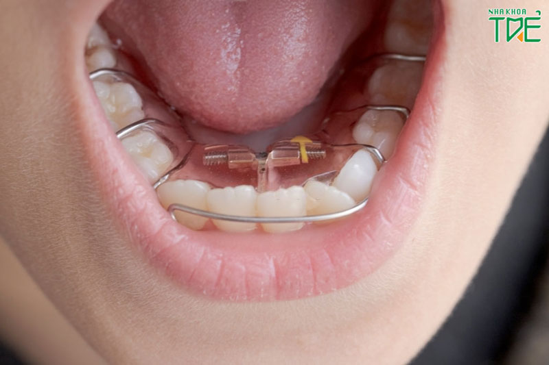 Niềng răng tháo lắp kim loại có hiệu quả không?