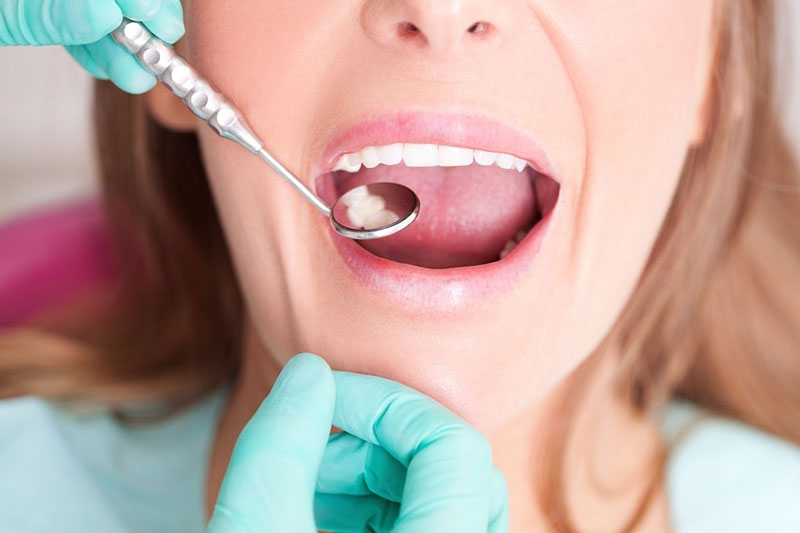 Nên khám răng định kỳ 6 tháng/lần sau bọc răng sứ