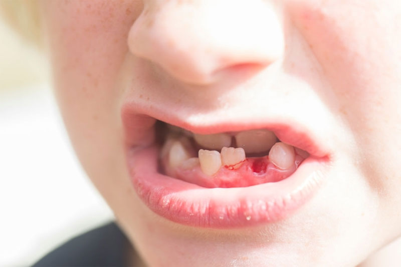 Răng sữa của bé bị mủn có nguy cơ khiến răng vĩnh viễn sau này mọc lệch