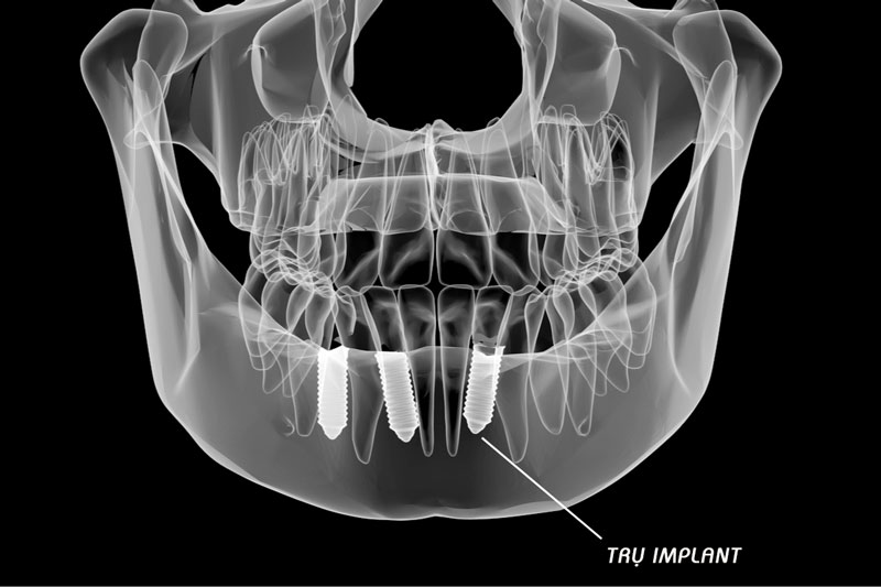 Trồng răng Implant khôi phục từ chân răng giúp ngăn ngừa tiêu xương hàm