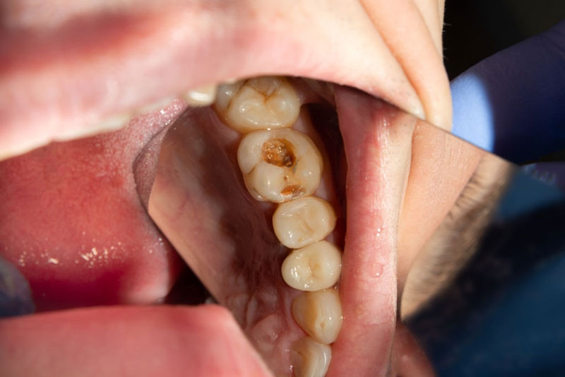 Răng hàm bị sâu nên nhổ bỏ khi nào?