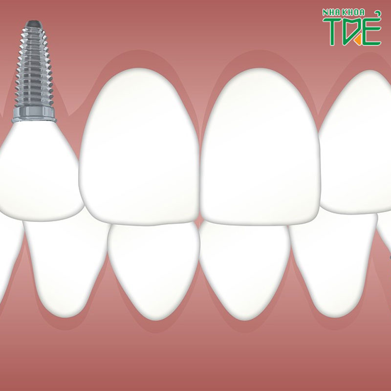 Trồng răng Implant có bền không? Tuổi thọ tối đa của răng Implant là bao lâu?Trồng răng Implant có bền không? Tuổi thọ tối đa của răng Implant là bao lâu?