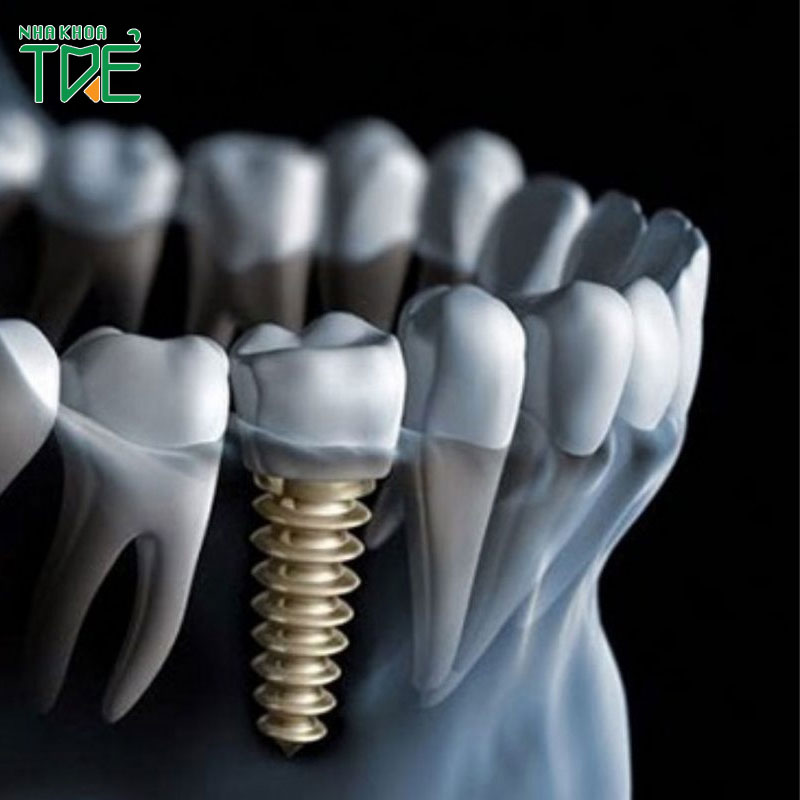 Trụ Implant Dentium Mỹ - Ưu điểm vượt trội và mức giá chi tiết