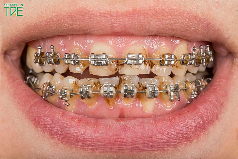 Nguyên nhân bị tụt lợi khi niềng răng và cách điều trị đứt điểm