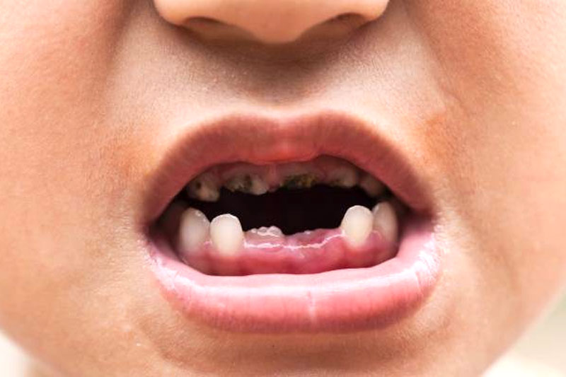 Nên nhổ răng khi răng bé đã bị sâu nặng, viêm tủy