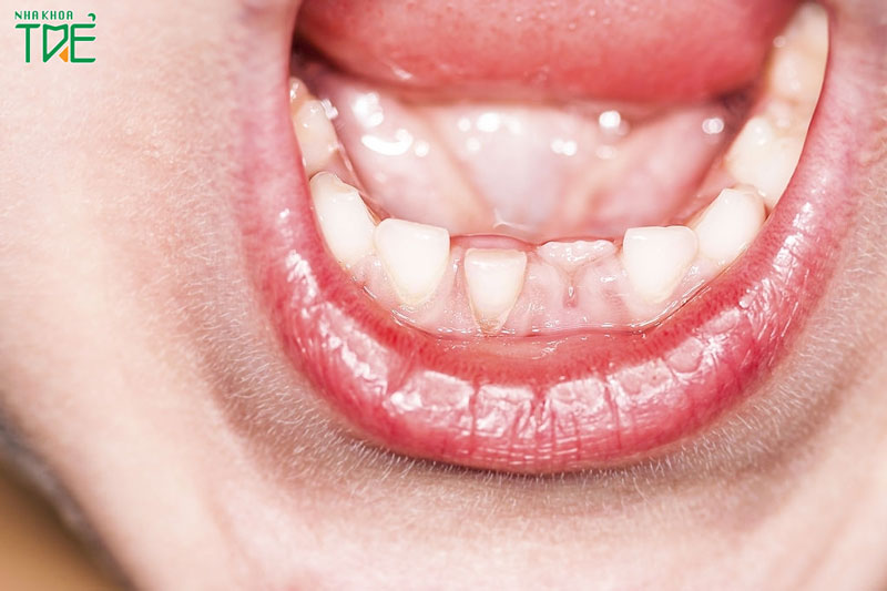Bé 6 tuổi mọc răng lệch phải làm sao để khắc phục?
