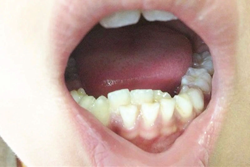 Bé mọc răng quá muộn có thể dẫn đến tình trạng hàm răng đôi