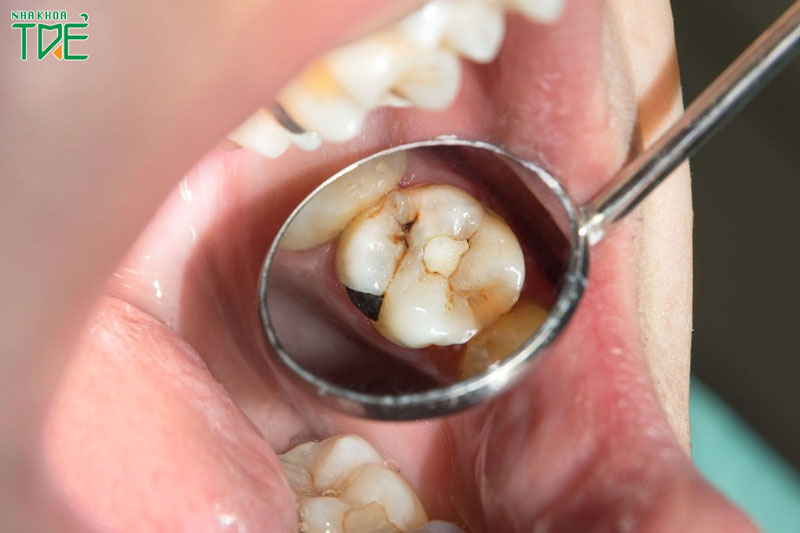 Bọc răng sứ cho răng hàm bị sâu có thật sự cần thiết?